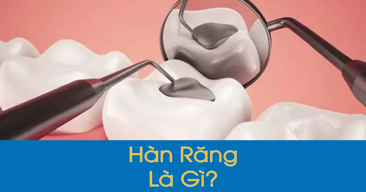 Hàn Răng Là Gì? Hàn Răng Có Đau Không? Bảng giá