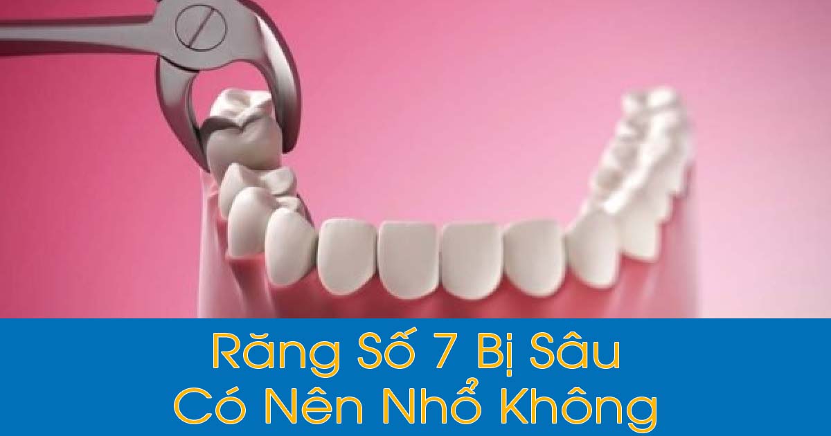 Răng Số 7 Bị Sâu Có Nên Nhổ Không