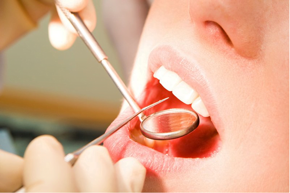 Trám Răng Amalgam là gì? Trám răng bằng Amalgam có độc không?