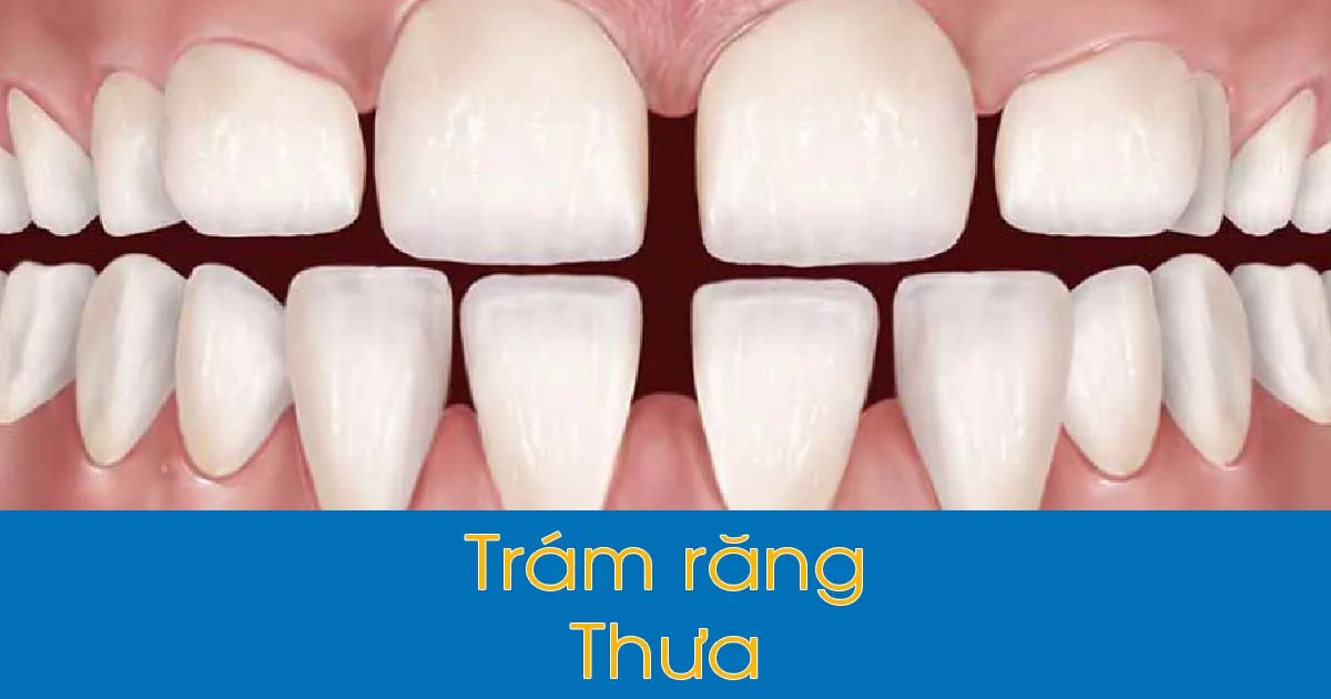 Trám Răng Thưa Bao Nhiêu Tiền? Tìm Hiểu Chi Phí và Quy Trình Chi Tiết