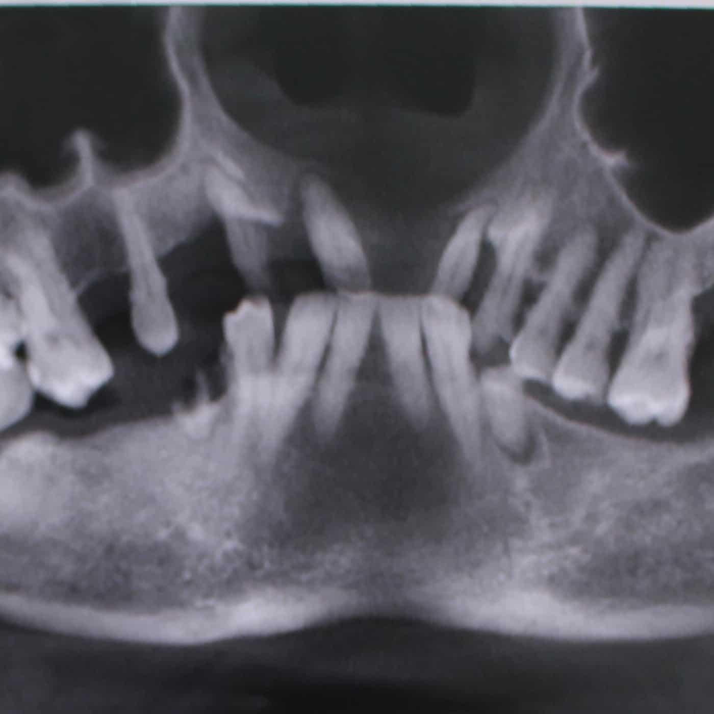 Hiện tượng xương bị mất biểu hiện trên phim CT