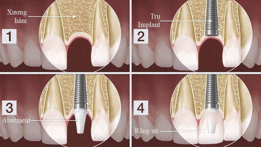 Quy trình trồng răng Implant