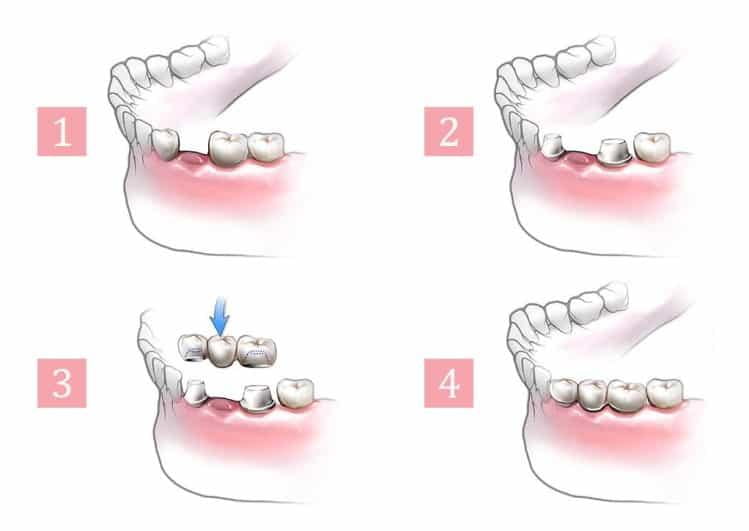 Mô phỏng kỹ thuật làm cầu răng sứ