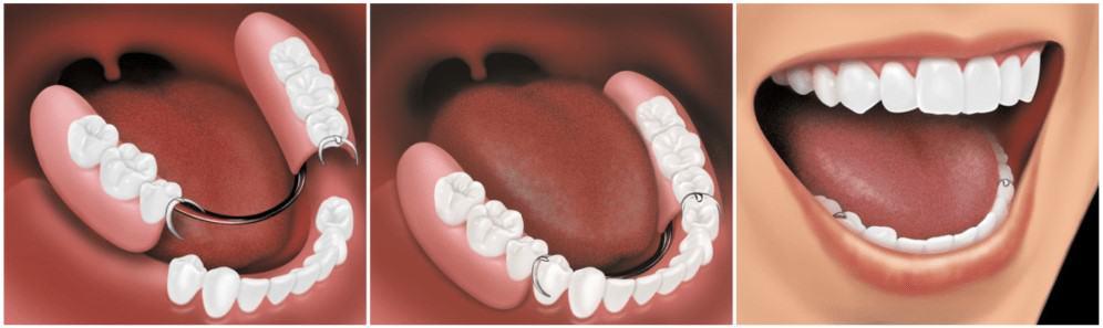 Răng giả tháo lắp