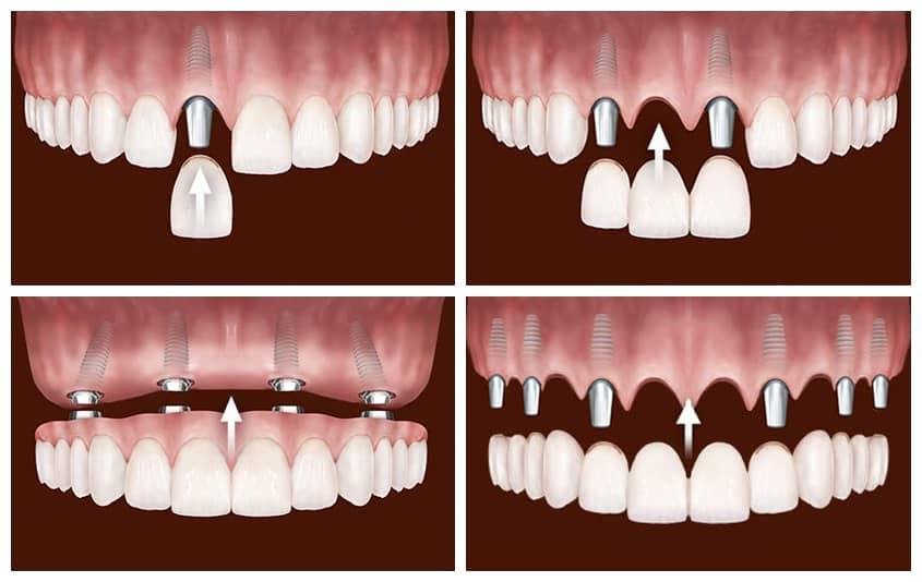 Các kỹ thuật trồng Implant