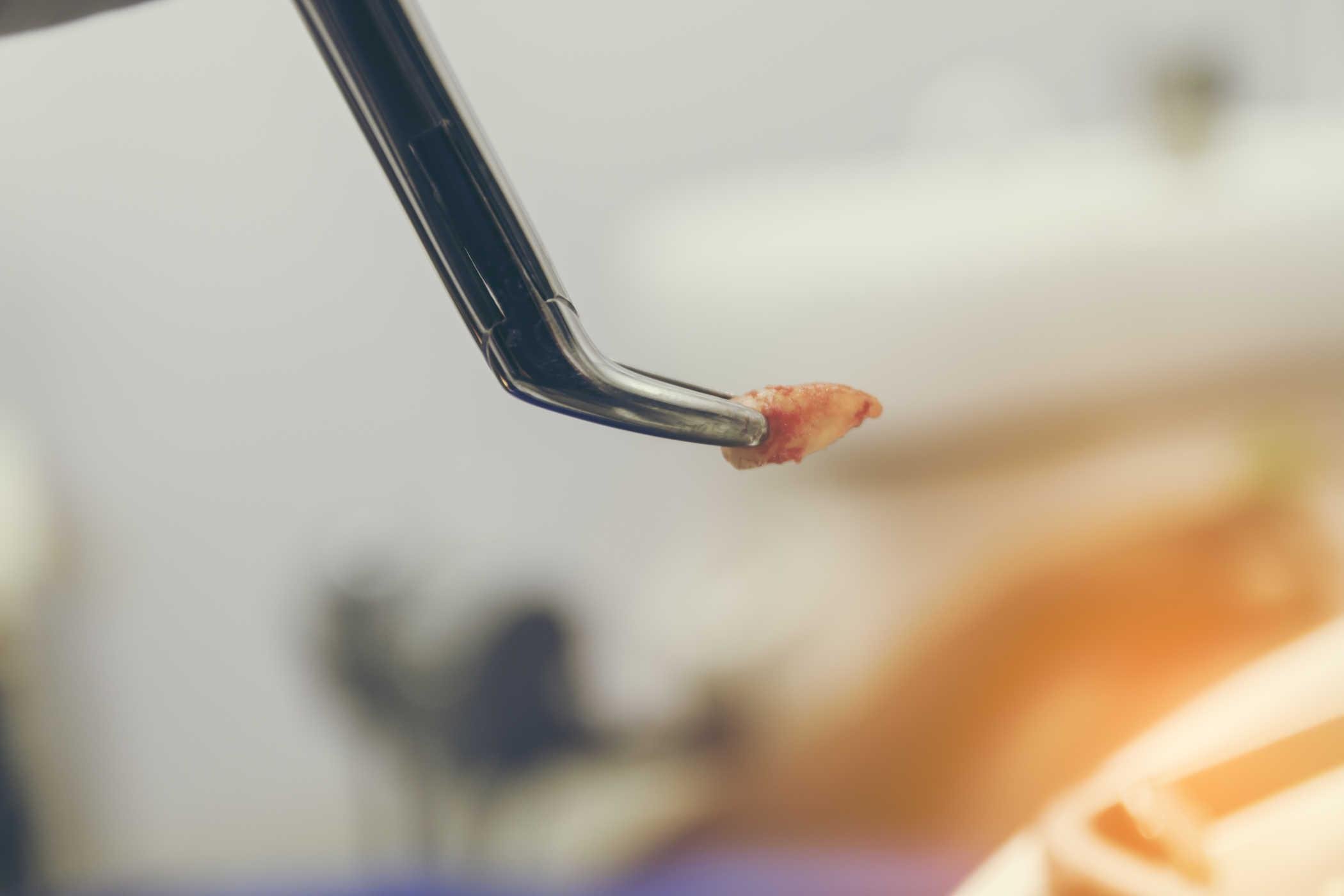 nhổ răng khôn ở đâu