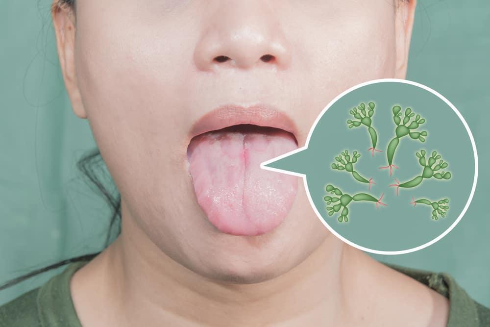 nguyên nhân viêm lưỡi bản đồ