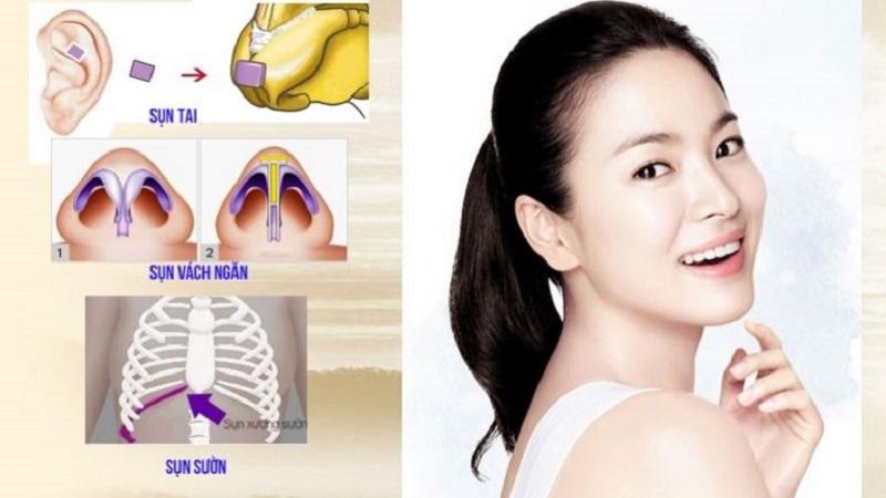 Sụn nâng mũi tốt nhất hiện nay có rất nhiều loại