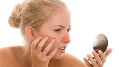 đầu mũi đỏ ửng, bất ngờ mọc mụn hay nốt ruồi
