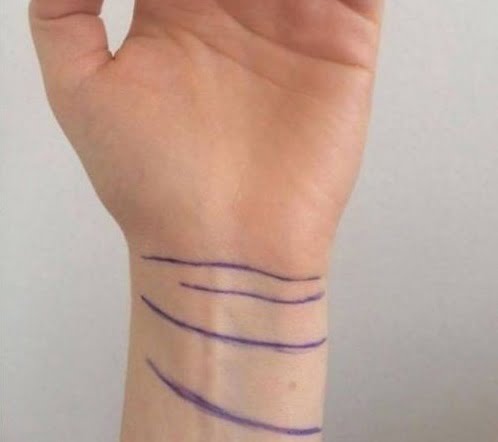 Đường vân cổ tay thứ tư