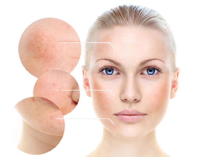 sản phẩm trị nám