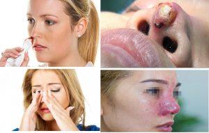 Cần nên kiêng cử bún chả cá ít nhất 4 - 8 tuần sau nâng mũi