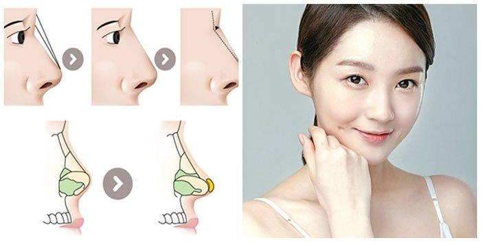 Nâng mũi giúp cải thiện diện mạo gương mặt thanh tú hơn