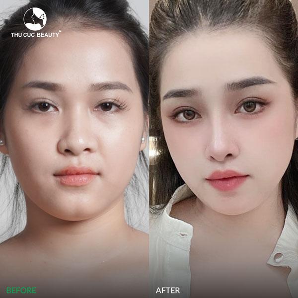 kết quả làm mũi cao