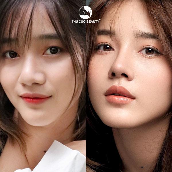 phẫu thuật mũi cao