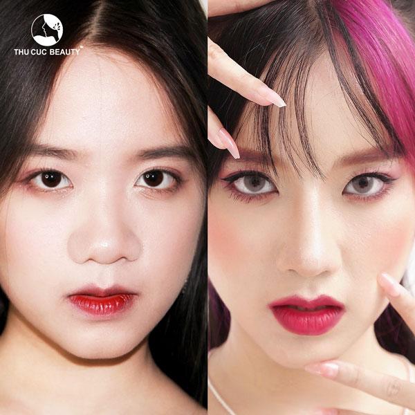 kết quả sau nâng mũi