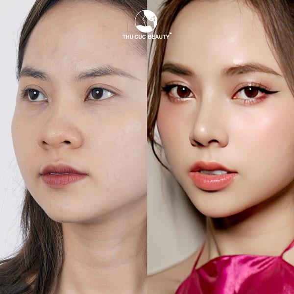 nâng mũi ở thu cúc