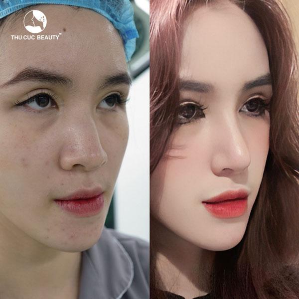 khách làm mũi cao