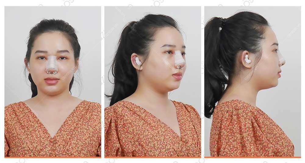 Mụn li ti hay mụn đầu đen sẽ giảm dần theo thời gian