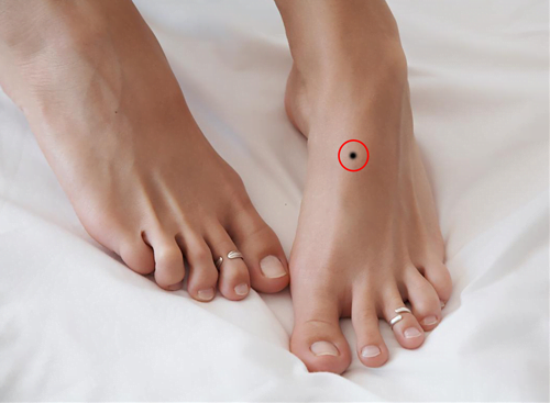 Nốt ruồi trên mu bàn chân phải chạy vạy