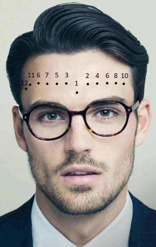 nốt ruồi ở trán