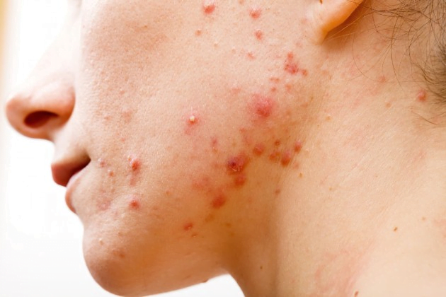 Đặc điểm của da dầu mụn là gì?