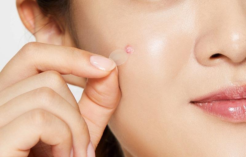 Miếng dán mụn thông thường