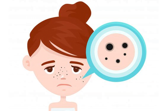 Mụn đầu đen không gây hại đến sức khỏe nhưng ảnh hưởng đến thẩm mỹ của gương mặt