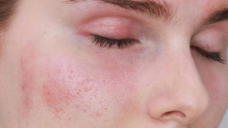 Những nguyên nhân khiến cho làn da bị nhạy cảm