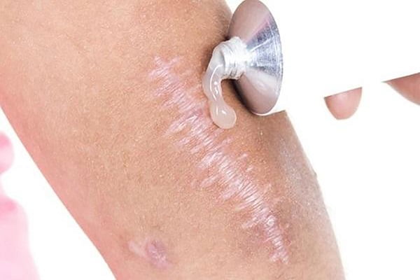 Bôi kem ngoài là phương pháp tối ưu trong việc điều trị sẹo