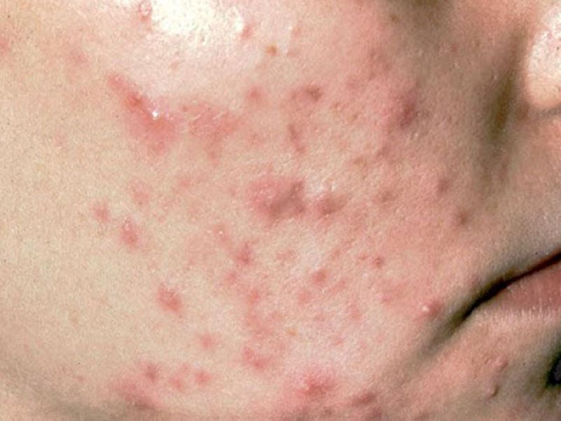 Loại mụn viêm nhưng không có nhân gây khó chịu cho người bị