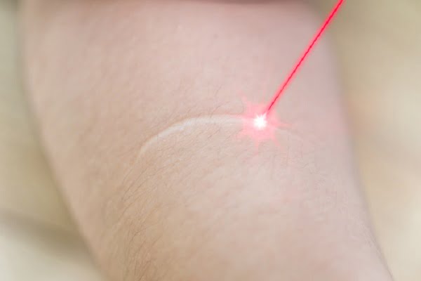Phương pháp điều trị bằng laze rất phổ biến trong da liễu