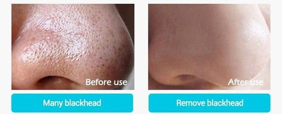 Những cách sau đây sẽ giúp bạn loại bỏ mụn đầu đen hiệu quả