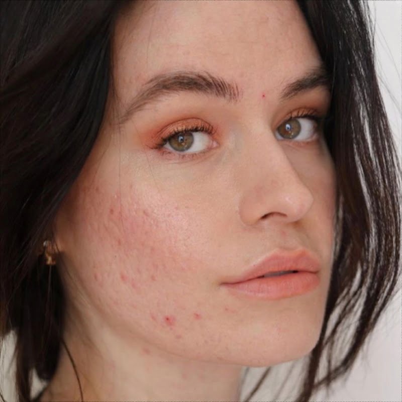 Da mụn cũng cần được loại bỏ lớp dầu thừa