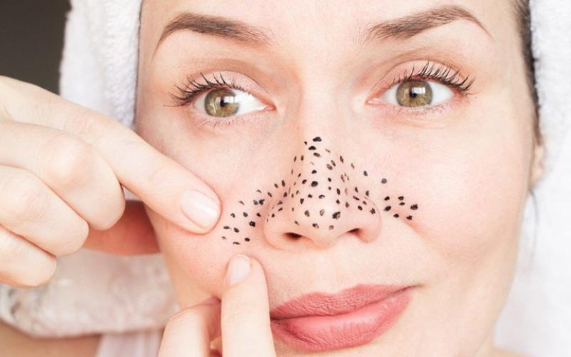 Mụn đầu đen hình thành như thế nào