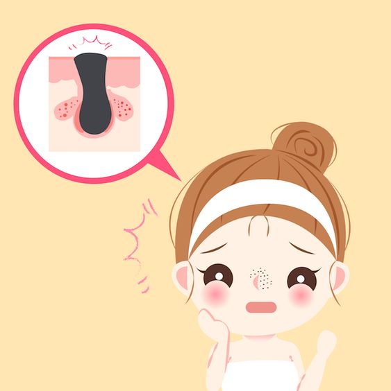 Ghi nhớ những lưu ý sau để mụn đầu đen biến mất