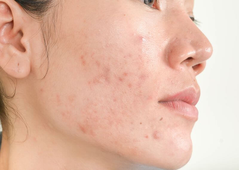 Mụn viêm đỏ không nhân