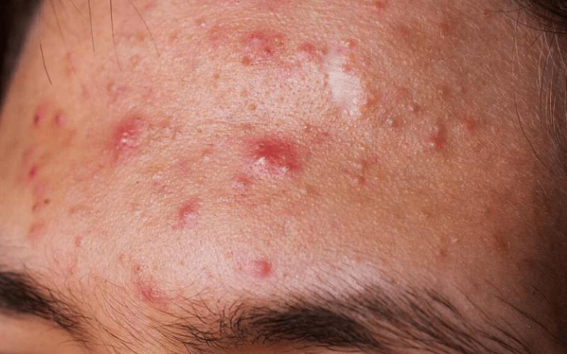 Tắc nghẽn lỗ chân lông gây ra loại mụn không nhân viêm đỏ