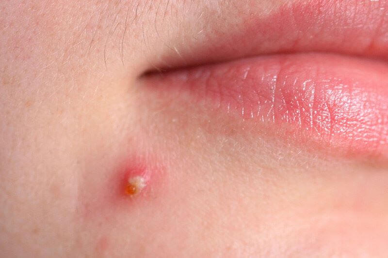 Mụn viêm mủ trên da