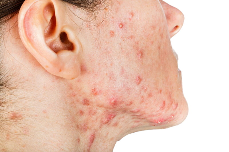 Mụn viêm ngứa gây tổn thương da rất lớn