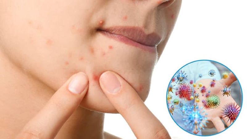 Chạm tay vào nốt mụn viêm khiến tình trạng tồi tệ hơn