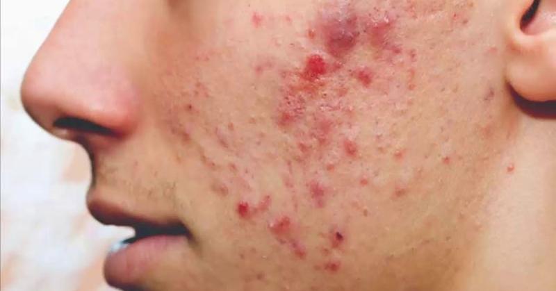 Dạng mụn đỏ phổ biến