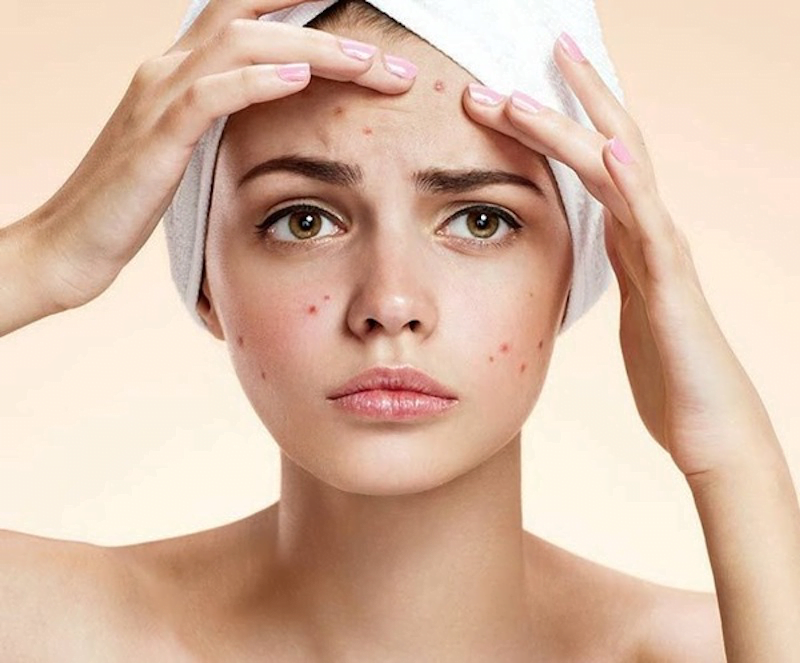 Nhận biết các dạng mụn để điều trị hiệu quả