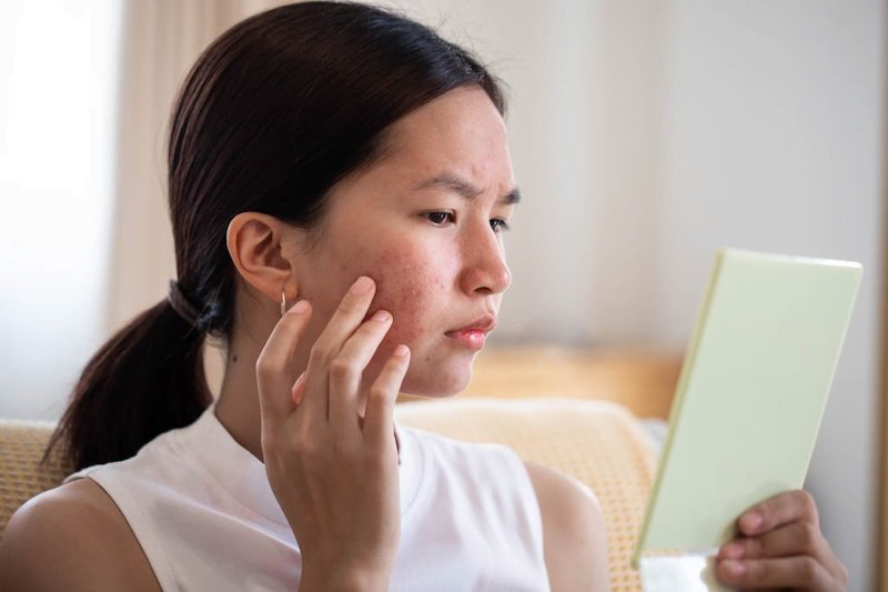 Những vết thâm do mụn ẩn để lại rất khó điều trị