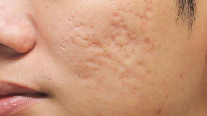 Sẹo thâm trên mặt