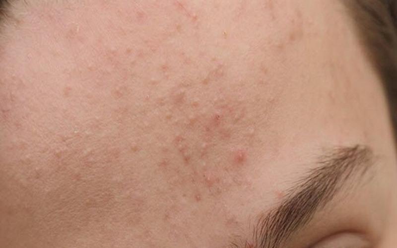 Nước tẩy trang La Roche-Posay Effaclar Micellar Cleansing Water