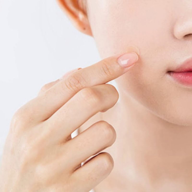 Miếng dán mụn hiệu quả