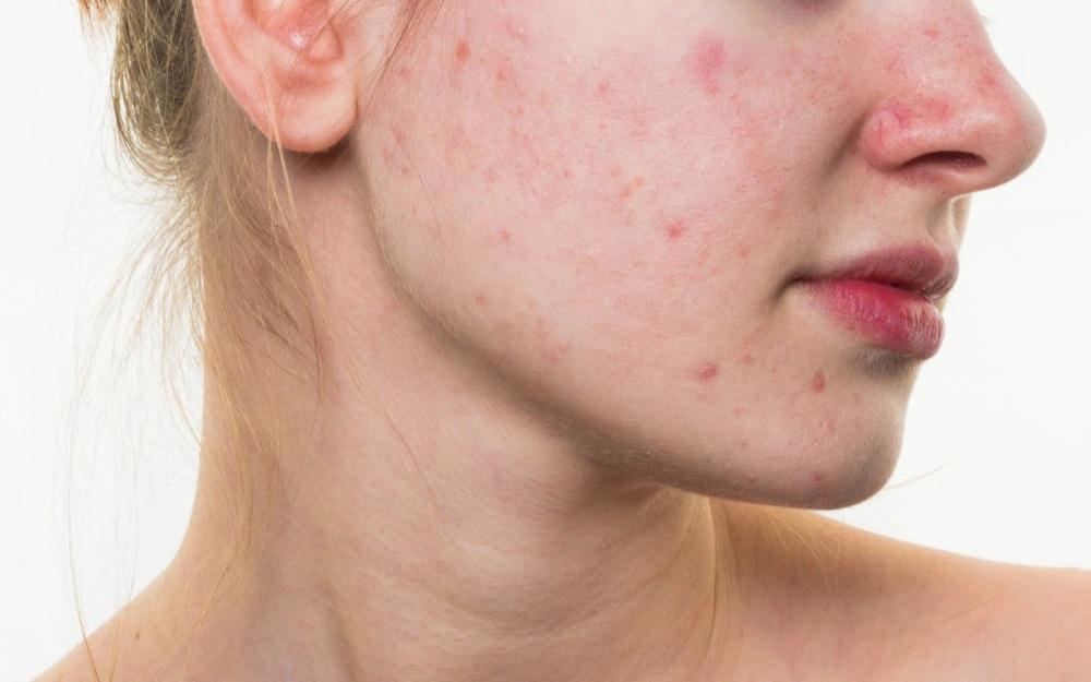 Các tác nhân gây ra mụn trứng cá là gì?