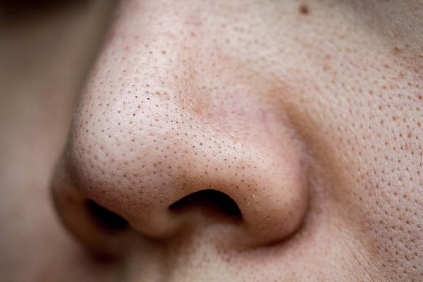 Lỗ chân lông to gây nhờn rít