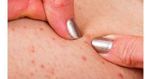 Chạm vào mụn có thể gây viêm nặng hơn